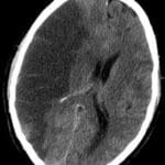 stroke unit- ischemic stroke