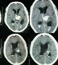 MRI of brain showing intracranial hemorrhage