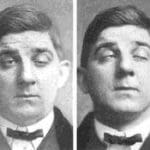 neuro-icu notes on myasthenic crisis