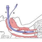 intubation procedure