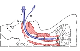 intubation procedure