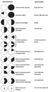 neuro-ophthalmology : visual defects associated with visual pathways