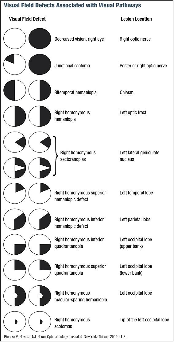 neuro-ophthalmology : visual defects associated with visual pathways