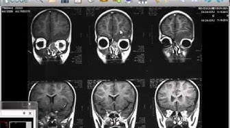 neuro-radiology - brain CT scan and MRI