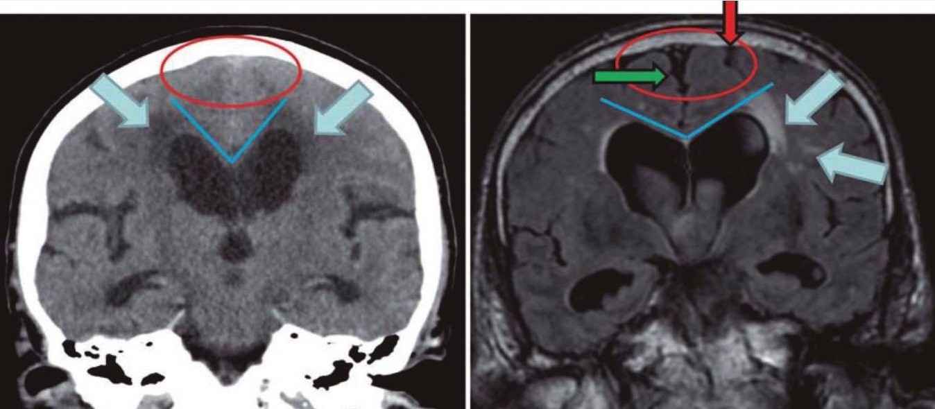 Normal_pressure_hydrocephalus_versus_atrophy