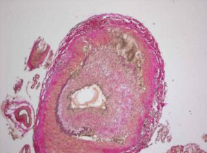 vasculitis